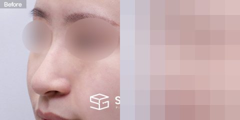 슈가성형외과 첫) 코끝+매부리코+휜코+복코+절골+비중격 전후사진 - 정면 수술 전후 비교
