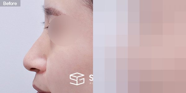 슈가성형외과 첫) 코끝+매부리코+휜코+복코+절골+비중격 전후사진 - 45도 수술 전후 비교