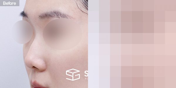 슈가성형외과 첫) 콧대+코끝+매부리코+짧은코+비중격연장+비주연장+자가늑 전후사진 - 정면 수술 전후 비교