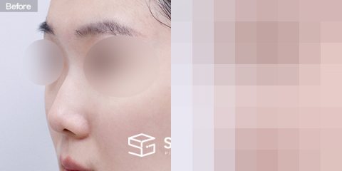 슈가성형외과 첫) 콧대+코끝+매부리코+짧은코+비중격연장+비주연장+자가늑 전후사진 - 정면 수술 전후 비교