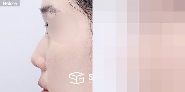 슈가성형외과 첫) 콧대+코끝+매부리코+짧은코+비중격연장+비주연장+자가늑 전후사진 - 45도 수술 전후 비교