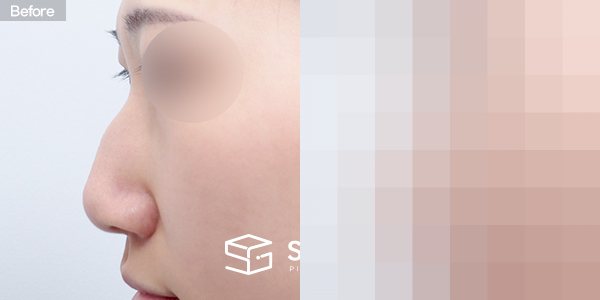 슈가성형외과 첫) 무보형물+비중격연장+매부리코+절골+복코 전후사진 - 45도 수술 전후 비교