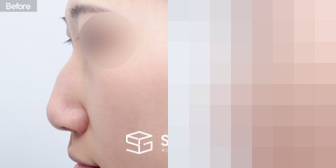 슈가성형외과 첫) 무보형물+비중격연장+매부리코+절골+복코 전후사진 - 45도 수술 전후 비교