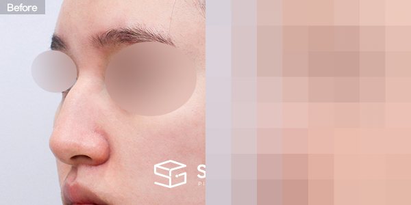 슈가성형외과 첫) 무보형물+매부리코+절골+콧볼축소+비주교정+비중격+귀뒤근막 전후사진 - 정면 수술 전후 비교
