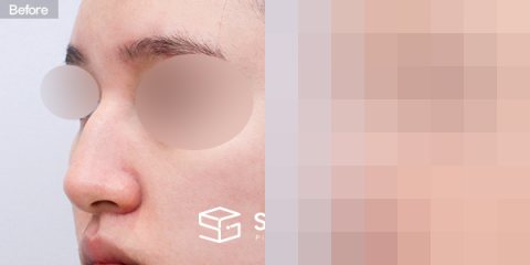 슈가성형외과 첫) 무보형물+매부리코+절골+콧볼축소+비주교정+비중격+귀뒤근막 전후사진 - 정면 수술 전후 비교
