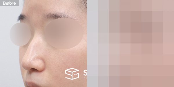 슈가성형외과 첫) 무보형물+매부리코+비중격연장+복코+콧볼축소+귀연골 전후사진 - 정면 수술 전후 비교