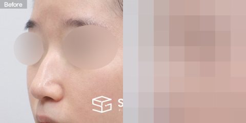 슈가성형외과 첫) 무보형물+매부리코+비중격연장+복코+콧볼축소+귀연골 전후사진 - 정면 수술 전후 비교