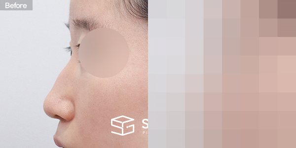 슈가성형외과 첫) 무보형물+매부리코+비중격연장+복코+콧볼축소+귀연골 전후사진 - 45도 수술 전후 비교