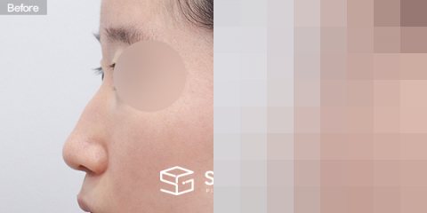 슈가성형외과 첫) 무보형물+매부리코+비중격연장+복코+콧볼축소+귀연골 전후사진 - 45도 수술 전후 비교