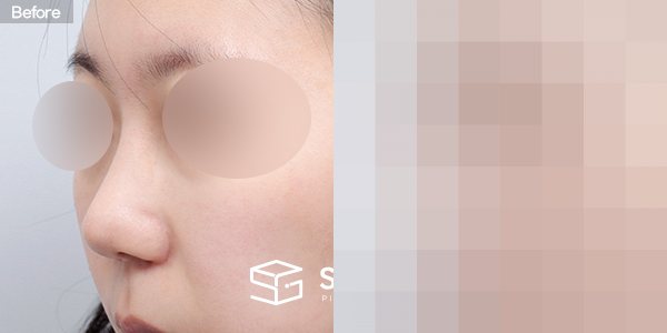 슈가성형외과 첫) 무보형물+절골+복코+귀연골 전후사진 - 정면 수술 전후 비교