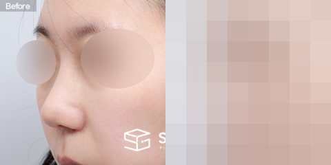 슈가성형외과 첫) 무보형물+절골+복코+귀연골 전후사진 - 정면 수술 전후 비교