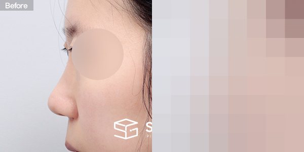 슈가성형외과 첫) 무보형물+절골+복코+귀연골 전후사진 - 45도 수술 전후 비교