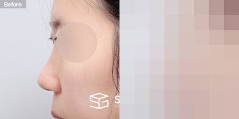 슈가성형외과 첫) 무보형물+절골+복코+귀연골 전후사진 - 45도 수술 전후 비교