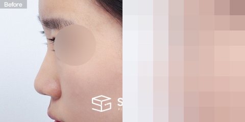 슈가성형외과 첫) 콧대+코끝+절골+콧대다듬기+복코+기증늑 전후사진 - 45도 수술 전후 비교