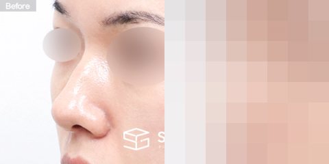 슈가성형외과 첫) 콧대 + 코끝 + 복코 + 휜코 전후사진 - 정면 수술 전후 비교
