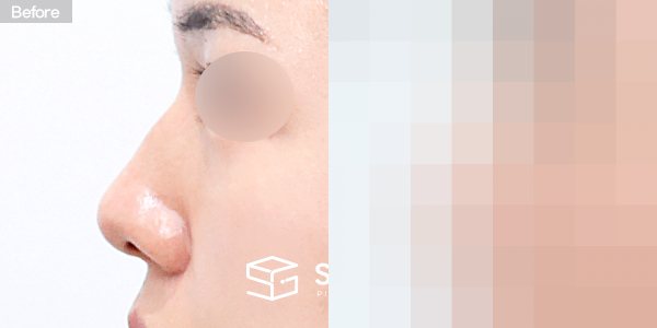 슈가성형외과 첫) 콧대 + 코끝 + 복코 + 휜코 전후사진 - 45도 수술 전후 비교