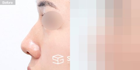 슈가성형외과 첫) 콧대 + 코끝 + 복코 + 휜코 전후사진 - 45도 수술 전후 비교