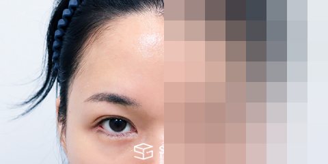 슈가성형외과 재) 뒤밑트임 재수술 + 이마거상 전후사진 - 정면 수술 전후 비교