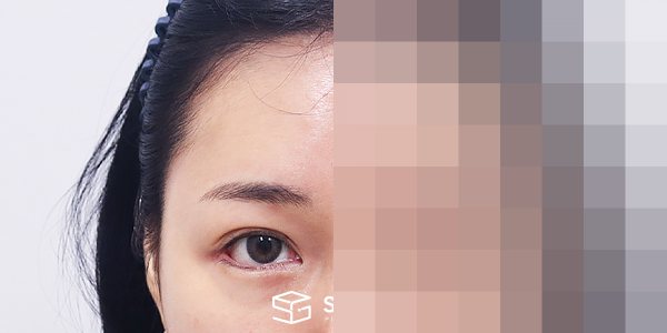 슈가성형외과 재) 뒤밑트임 재수술 + 이마거상 전후사진 - 45도 수술 전후 비교