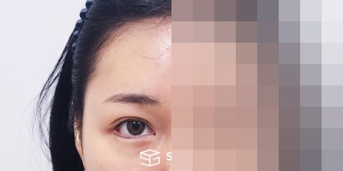 슈가성형외과 재) 뒤밑트임 재수술 + 이마거상 전후사진 - 45도 수술 전후 비교