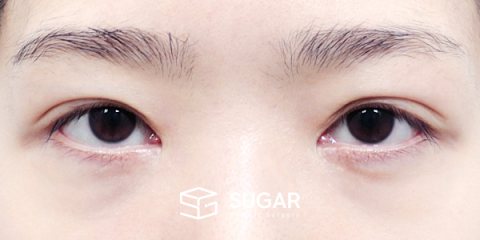 슈가성형외과 재) 재수술 + 절개 + 눈매교정 전후사진 - 수술 전