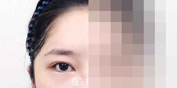 슈가성형외과 재) 뒤밑트임 재수술 + 이마거상 전후사진 - 정면 수술 전후 비교