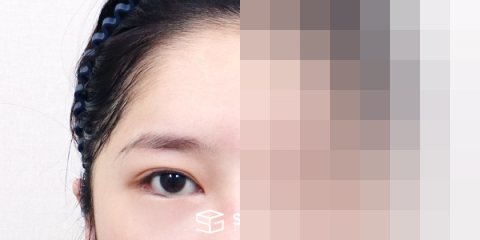 슈가성형외과 재) 뒤밑트임 재수술 + 이마거상 전후사진 - 정면 수술 전후 비교