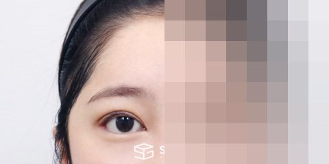 슈가성형외과 재) 뒤밑트임 재수술 + 이마거상 전후사진 - 45도 수술 전후 비교