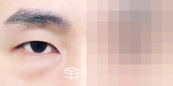 슈가성형외과 첫) 눈밑지방재배치 전후사진 - 정면 수술 전후 비교