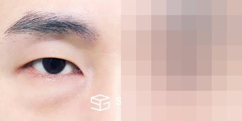 슈가성형외과 첫) 눈밑지방재배치 전후사진 - 정면 수술 전후 비교