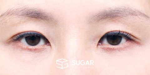 슈가성형외과 첫) 눈썹 거상 + 윗트임 + 뒤밑트임 전후사진 - 수술 전
