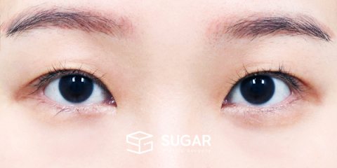 슈가성형외과 첫) 절개 + 윗트임 + 뒤밑트임 전후사진 - 수술 전