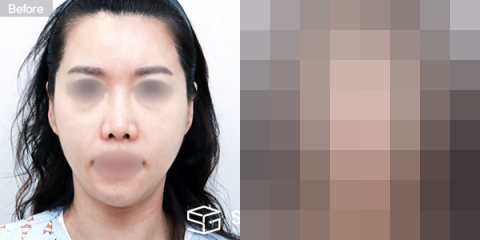 슈가성형외과 첫) 중안면부거상 + 풀페이스 지방이식 + 이중턱 지방흡입 + 실리프팅 전후사진 - 정면 수술 전후 비교