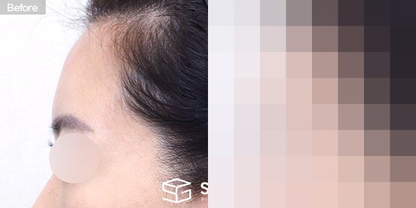 슈가성형외과 첫) 이마 지방이식 전후사진 - 정면 수술 전후 비교