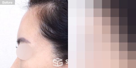 슈가성형외과 첫) 이마 지방이식 전후사진 - 정면 수술 전후 비교