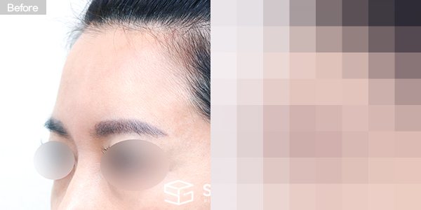 슈가성형외과 첫) 이마 지방이식 전후사진 - 45도 수술 전후 비교