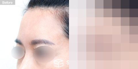 슈가성형외과 첫) 이마 지방이식 전후사진 - 45도 수술 전후 비교