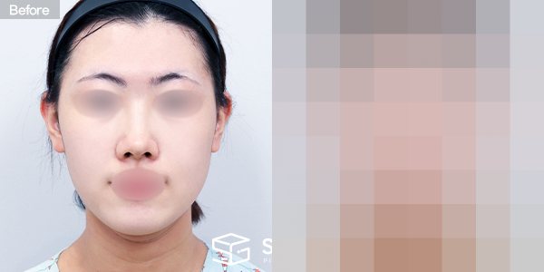 슈가성형외과 첫) 풀페이스 지방이식 + 이중턱 지방흡입 + 실리프팅 + 이마,미간 보톡스 전후사진 - 정면 수술 전후 비교