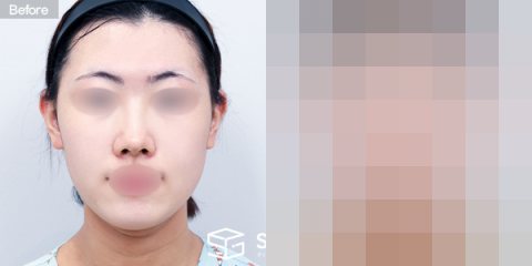 슈가성형외과 첫) 풀페이스 지방이식 + 이중턱 지방흡입 + 실리프팅 + 이마,미간 보톡스 전후사진 - 정면 수술 전후 비교