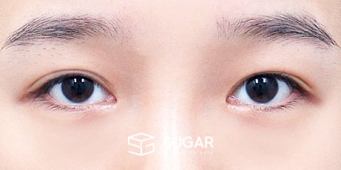 슈가성형외과 재) 자연유착 재수술 + 눈매교정 + 뒤밑트임 전후사진 - 수술 전