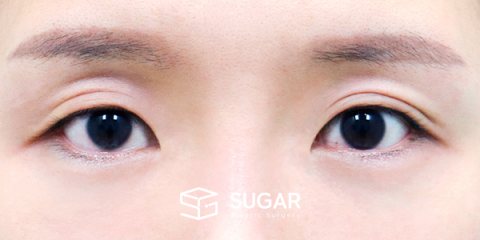 슈가성형외과 재) 절개 재수술 + 눈 두덩이 지방재배치 + 윗트임 + 앞트임 + 뒤밑트임 전후사진 - 수술 전