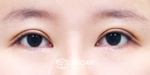 슈가성형외과 재) 밑트임 재수술 전후사진 - 수술 전