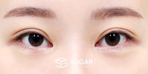 슈가성형외과 첫) 뒤트임 전후사진 - 수술 전
