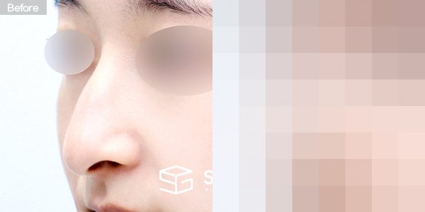 슈가성형외과 첫) 무보형물 + 콧대 + 코끝 + 매부리 + 비중격연장 + 귀연골 + 귀 뒤 근막 + 비순각교정 전후사진 - 정면 수술 전후 비교