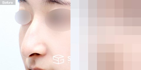 슈가성형외과 첫) 무보형물 + 콧대 + 코끝 + 매부리 + 비중격연장 + 귀연골 + 귀 뒤 근막 + 비순각교정 전후사진 - 정면 수술 전후 비교