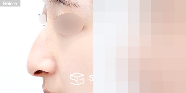 슈가성형외과 첫) 무보형물 + 콧대 + 코끝 + 매부리 + 비중격연장 + 귀연골 + 귀 뒤 근막 + 비순각교정 전후사진 - 45도 수술 전후 비교
