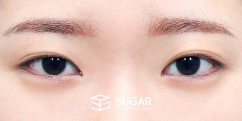 슈가성형외과 재) 절개 재수술 + 눈매교정 + 윗트임 + 뒤밑트임 + 안검내반 전후사진 - 수술 전