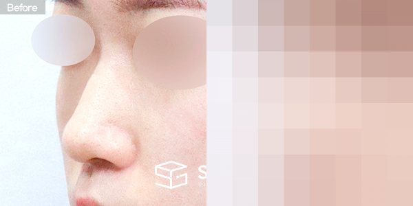 슈가성형외과 첫) 콧대 + 코끝 + 매부리 + 절골 + 비중격연장 + 귀연골 전후사진 - 정면 수술 전후 비교