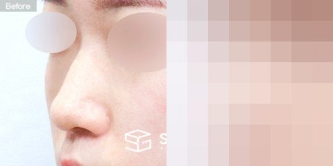 슈가성형외과 첫) 콧대 + 코끝 + 매부리 + 절골 + 비중격연장 + 귀연골 전후사진 - 정면 수술 전후 비교