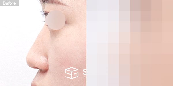 슈가성형외과 첫) 콧대 + 코끝 + 매부리 + 절골 + 비중격연장 + 귀연골 전후사진 - 45도 수술 전후 비교
